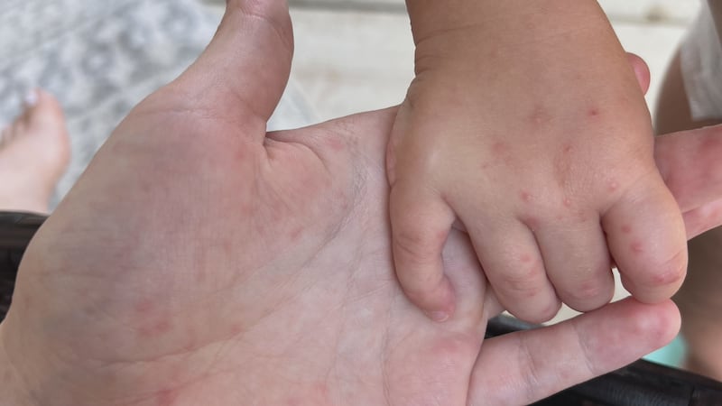 Dr. Landers says Hand Foot Mouth Disease is most commonly spread during the spring and summer.